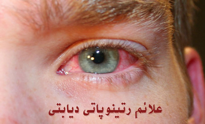 همه چی درباره رتینوپاتی دیابتی