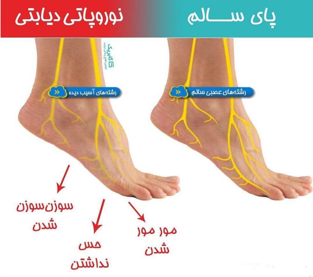 درمان خانگی نوروپاتی دیابتی